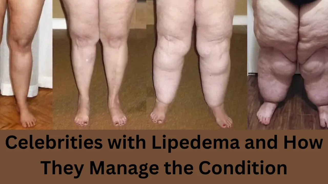 celebrities with lipedema